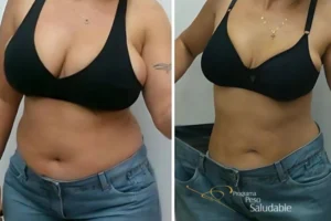 Comparación de antes y después del abdomen y cintura de una mujer que muestra una reducción visible de peso dentro del Programa Peso Saludable. La imagen del lado derecho evidencia un contorno más definido y un pantalón más suelto, resaltando el cambio físico logrado.